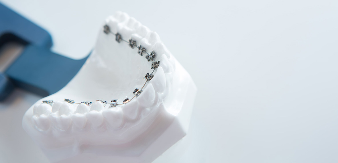 目立たない矯正治療