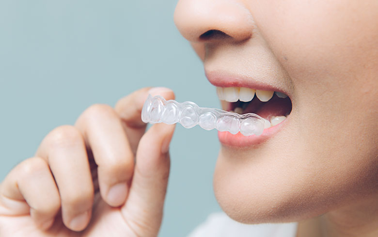 マウスピース型装置による治療(インビザライン)