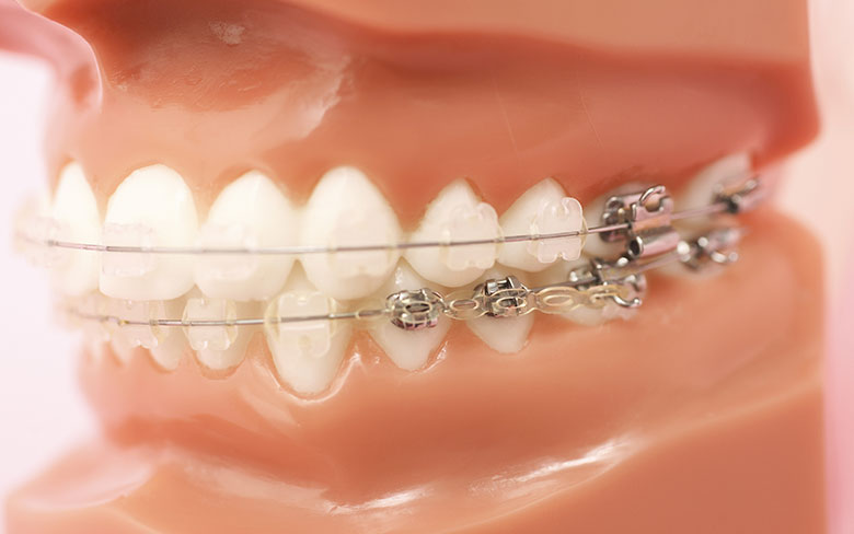 ワイヤー矯正による治療